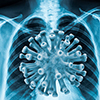 Coronavirus disease COVID-19 virus infection in human lungs