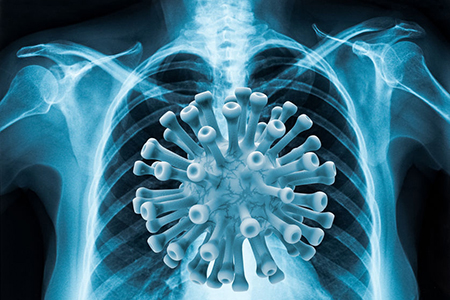 Coronavirus disease COVID-19 virus infection in human lungs